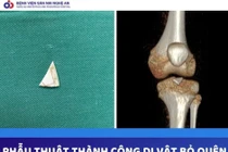 Hy hữu: Mảnh sành sắc nhọn bị "bỏ quên" 2 năm trong khớp gối