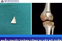 Hy hữu: Mảnh sành sắc nhọn bị "bỏ quên" 2 năm trong khớp gối