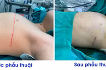 Chỉnh xương ức lồi như ức gà cho trẻ 3 tuổi