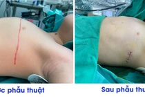 Chỉnh xương ức lồi như ức gà cho trẻ 3 tuổi