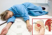 Nhiệt độ giảm sâu khiến đột quỵ não gia tăng?