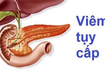 Ăn uống nhiều dễ gây viêm tụy nguy hiểm tính mạng