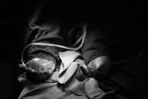 Cắt cụt cả 2 cẳng chân vì đái tháo đường không điều trị thường xuyên