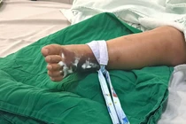 Rắn hổ mèo bò vào nhà nhiều trẻ bị cắn nhiễm độc toàn thân