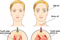 Điều trị bướu cổ Basedow bằng thuốc kháng giáp có an toàn?