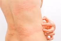 Chuyên gia mách cách xử lý đúng khi bị mày đay