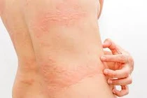 Chuyên gia mách cách xử lý đúng khi bị mày đay