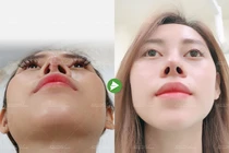 Bác sĩ chỉ cách chăm sóc sau nâng mũi