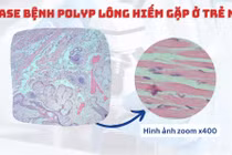 Trẻ vừa sinh xuất hiện suy hô hấp do khối Polyp lông