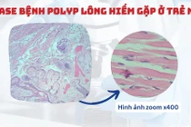 Trẻ vừa sinh xuất hiện suy hô hấp do khối Polyp lông