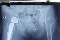 Thay khớp háng chuôi dài “cứu” gãy cổ xương đùi người già