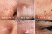 Chuyên gia mách các nguyên tắc trị mụn trứng cá hiệu quả