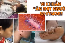 Cứu sống trẻ bị nhiễm vi khuẩn ăn thịt người