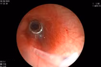 Lò so, hạt mãng cầu bít tắc đường thở của trẻ