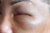 Bị lừa tiêm filler tại nhà nghỉ, 2 người bị tai biến và mất sạch tài sản