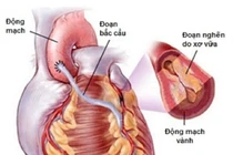 Chế độ dinh dưỡng cho người bệnh sau phẫu thuật bắc cầu tim