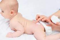 Bác sĩ chỉ cách tránh viêm da khi trẻ dùng bỉm