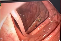 Nội soi phát hiện giun đũa 10 cm đang vận động trong đại tràng