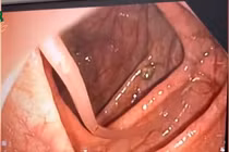 Nội soi phát hiện giun đũa 10 cm đang vận động trong đại tràng