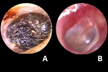  Ráy tai dài 4 cm đông đặc bịt kín tai trẻ khiến nghe kém