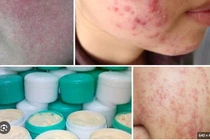 Điều trị da bôi kem trộn corticoid khó như cai nghiện ma túy