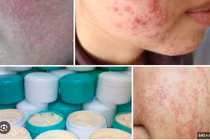 Điều trị da bôi kem trộn corticoid khó như cai nghiện ma túy