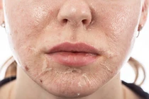 Da bong tróc khi làm đẹp bằng peel da sinh học