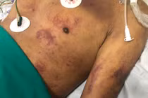 Xuất huyết hoại tử toàn thân sau 1 tuần làm và ăn thịt lợn ốm