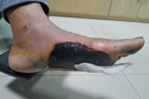 Hoại tử 2 bàn chân vì đái tháo đường dùng túi chườm nóng