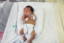 Phẫu thuật cho trẻ thủng ruột từ trong bào thai