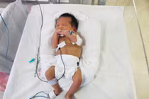 Phẫu thuật cho trẻ thủng ruột từ trong bào thai