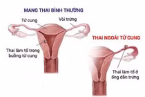  Một trường hợp thai làm tổ ngoài tử cung 