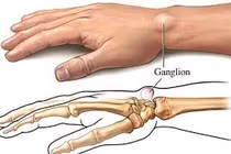 Địa chỉ vàng: Nơi điều trị u bao hoạt dịch khớp cổ tay