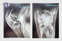 Bị mụn đắp thuốc dân tộc, bé 10 tuổi có nguy cơ không đi lại được