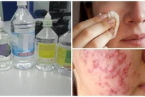 Rửa mặt nước muối có an toàn cho da?