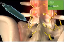 Đau lưng mạn tính, dai dẳng do hội chứng Bertolotti