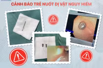 Hai chiếc đinh vít sắc nhọn, nguy hiểm trong bụng trẻ