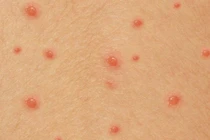 Chuyên gia mách cách bôi thuốc và kiêng ăn để thủy đậu nhanh khỏi