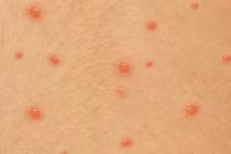 Chuyên gia mách cách bôi thuốc và kiêng ăn để thủy đậu nhanh khỏi