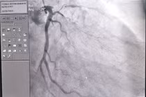 Lý do người đàn ông hẹp khít động mạch vành khi đi khám sức khỏe