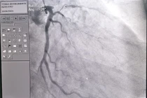 Lý do người đàn ông hẹp khít động mạch vành khi đi khám sức khỏe