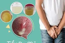 Đái buốt ra mủ là bệnh gì?