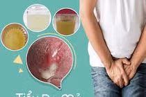 Đái buốt ra mủ là bệnh gì?