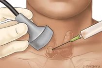 Ngưng thuốc chống đông máu khi chọc tuyến giáp có gây đột quỵ?