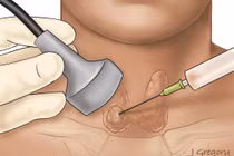 Ngưng thuốc chống đông máu khi chọc tuyến giáp có gây đột quỵ?