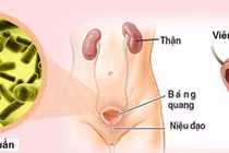 Bác sĩ chỉ rõ biểu hiện bạn bị viêm bàng quang