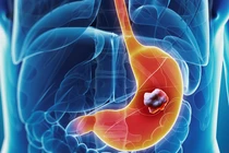 Chuyên gia chỉ rõ đối tượng và dấu hiệu "báo động đỏ" ung thư dạ dày