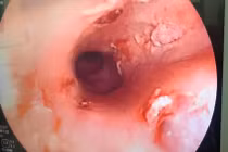 Gắp mảnh xương cá lớn cắm sâu trong thực quản người bệnh