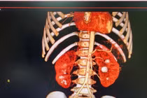 Mới 3 tuổi đã giãn bể thận do sỏi thận và sỏi niệu quản 2 bên