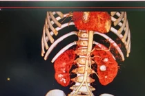 Mới 3 tuổi đã giãn bể thận do sỏi thận và sỏi niệu quản 2 bên